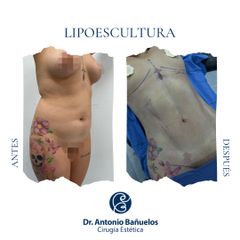 Lipoescultura - Dr. Antonio Bañuelos