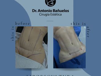 Lipoescultura antes y después - 868160