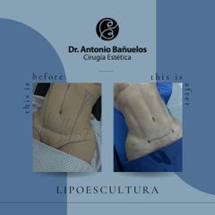 Lipoescultura secundaria - Dr. Antonio Bañuelos