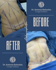 Lipoabdominoplastia - Dr. Antonio Bañuelos