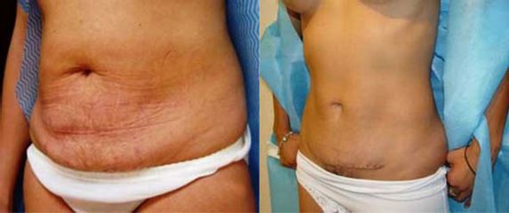 Antes y después de Liposucción