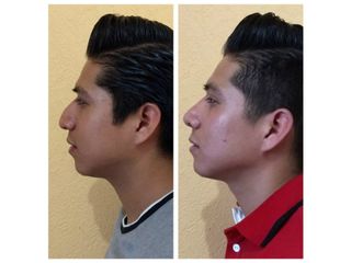 Antes y después de rinoplastia