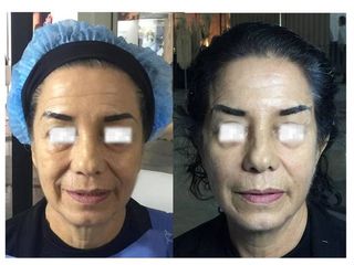Antes y después de Hilos de sustentación facial