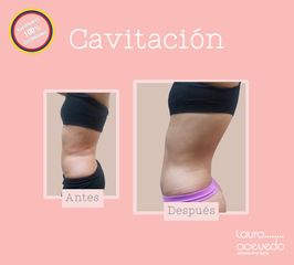 Antes y después de Cavitación 
