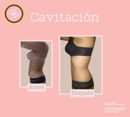 Antes y después de Cavitación 