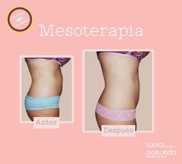 Antes y después de Mesoterapia 