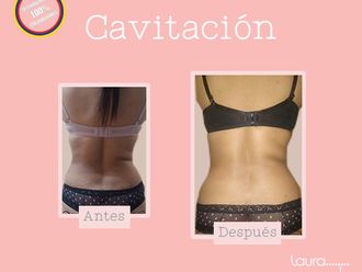 Cavitación antes y después - 663578
