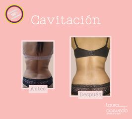 Antes y después de Cavitación 