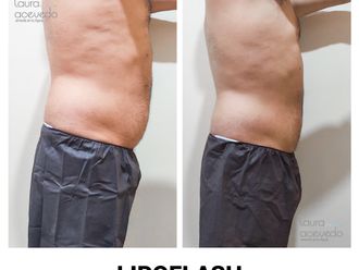 Drenaje linfático antes y después - 828354