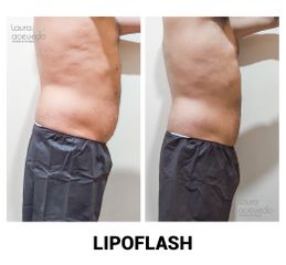 Lipoflash- Clínica Spa Laura Acevedo