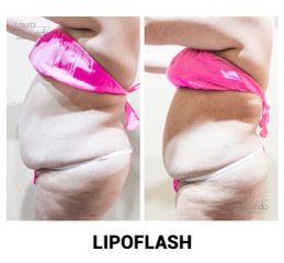 Lipoflash- Clínica Spa Laura Acevedo