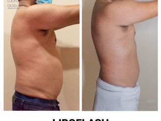 Drenaje linfático antes y después - 828356