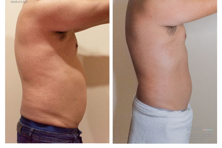 Drenaje linfático antes y después - 828356
