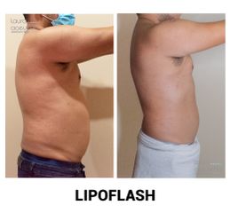 Lipoflash- Clínica Spa Laura Acevedo