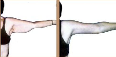 Antes y después de levantamiento de reducción de brazo