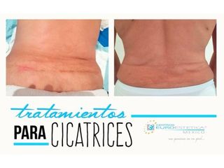 Tratamiento para cicatrices