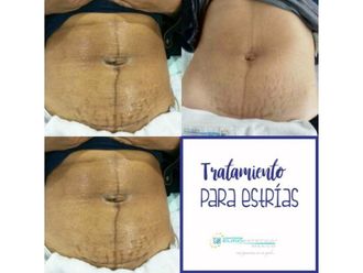Eliminación estrías antes y después - 641451