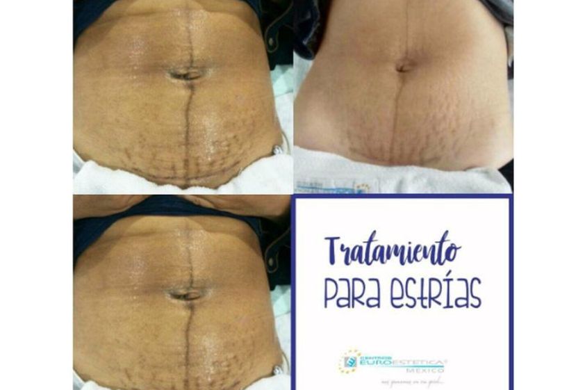 Eliminación estrías antes y después - 641451