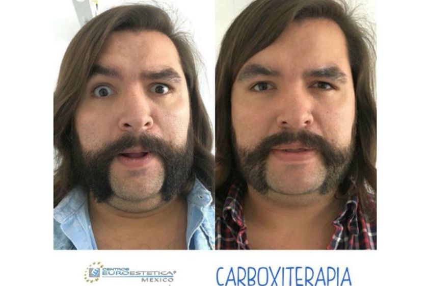Carboxiterapia antes y después - 641455