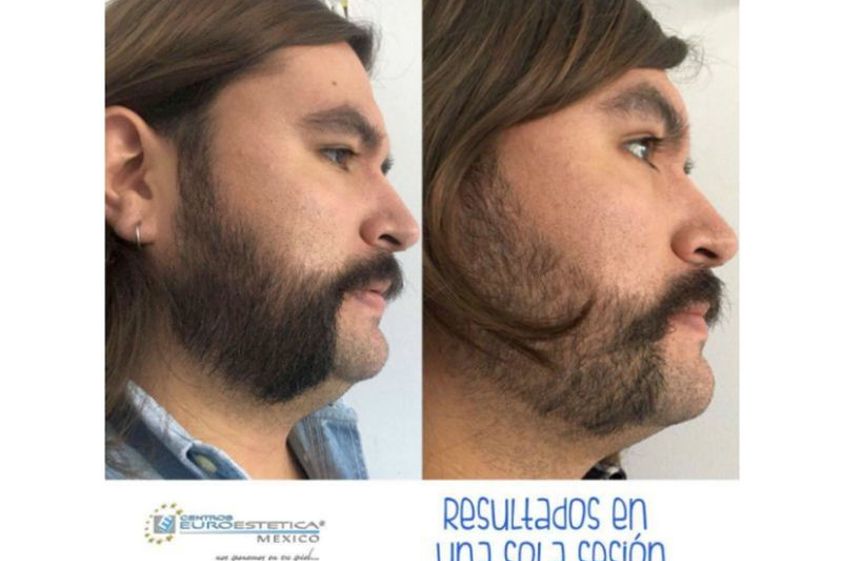 Carboxiterapia antes y después - 641456