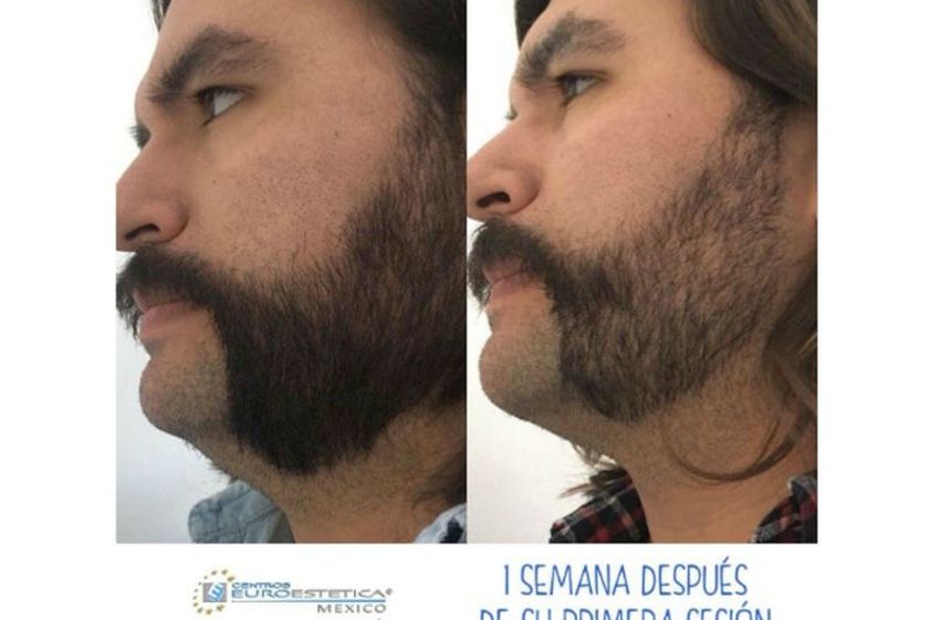 Carboxiterapia antes y después - 641457