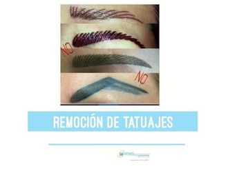 Eliminación de tatuajes - 641464