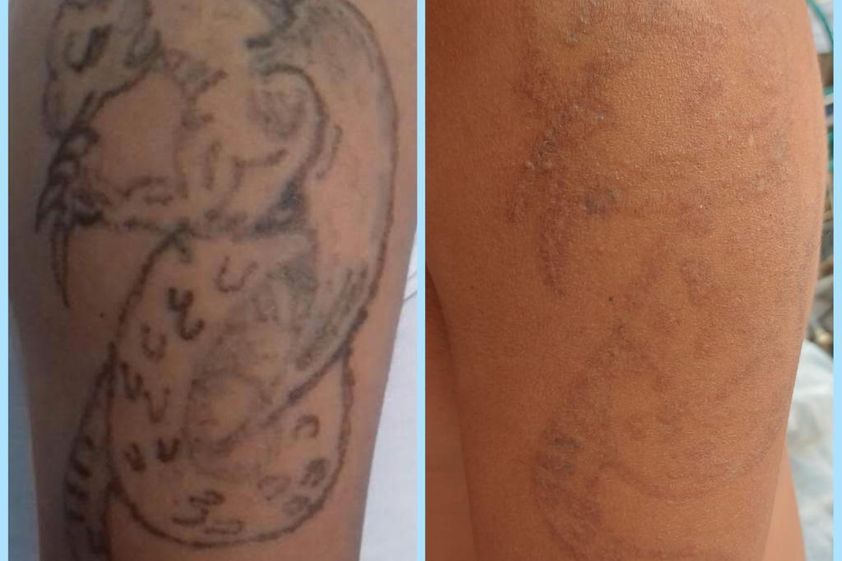 Eliminación de tatuajes antes y después - 836532