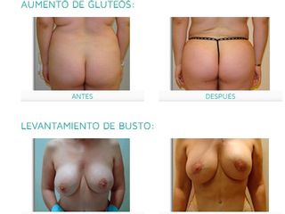 Antes y después Mommy makeover