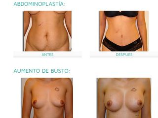 Antes y después Mommy makeover