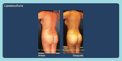 Antes y después de lipoescultura 