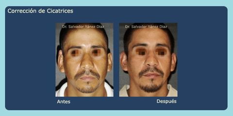 Antes y después de cirugía para cicatrices