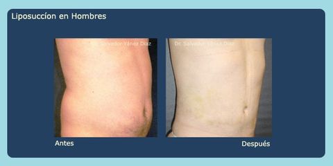 Antes y después de absominoplastia 