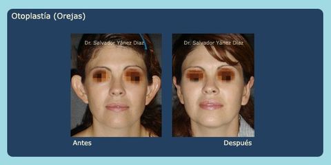 Antes y después de otoplastia 