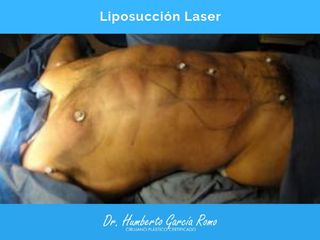 Resultado de Liposucción Laser