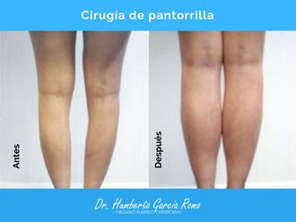 Aumento de pantorrillas antes y después - 638891