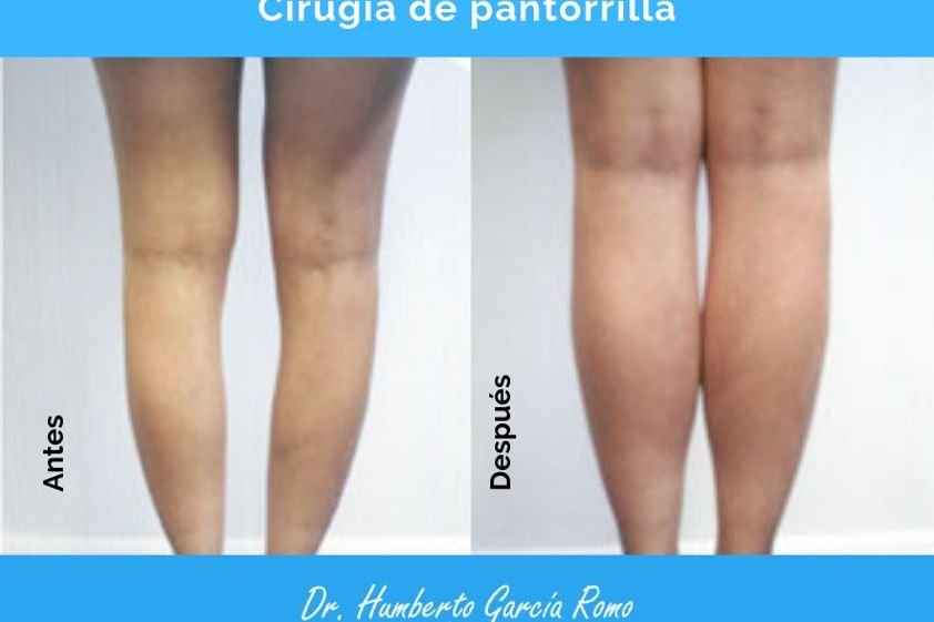 Aumento de pantorrillas antes y después - 638891