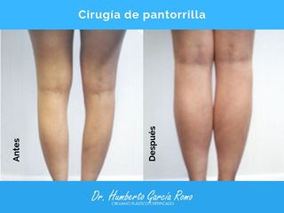 Antes y después de Aumento de Pantorrilla