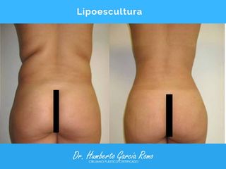 Antes y después de Lipoescultura