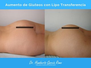 Antes y después de Aumento de Glúteos con Lipo Transferencia