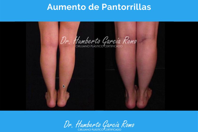 Aumento de pantorrillas antes y después - 663282