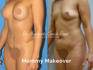 Antes y después de Mommy Makeover