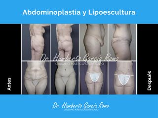 Abdominoplastia y Lipoescultura - Dr. Jorge Humberto García Romo