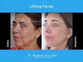 Lifting Facial - Dr. Jorge Humberto García Romo