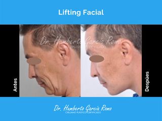 Lifting Facial - Dr. Jorge Humberto García Romo