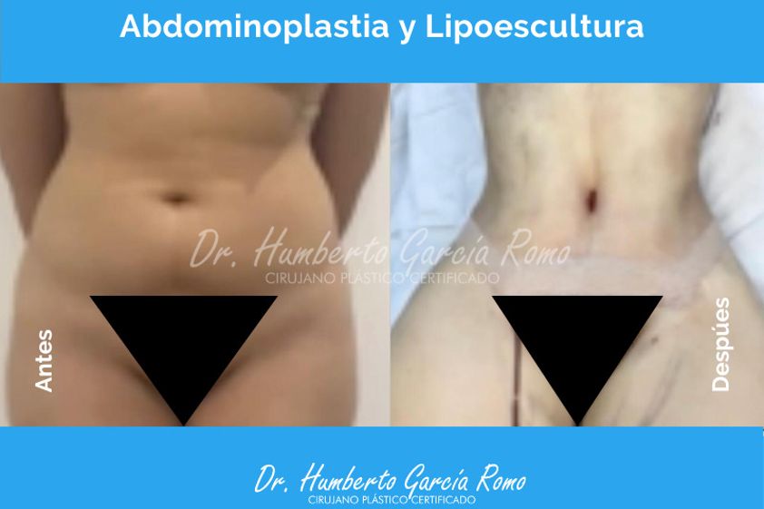 Abdominoplastia antes y después - 861859
