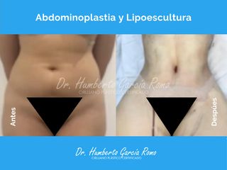 Abdominoplastia y Lipoescultura - Dr. Jorge Humberto García Romo