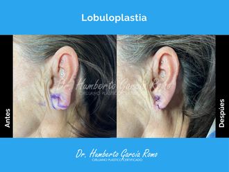 Otoplastia antes y después - 867544