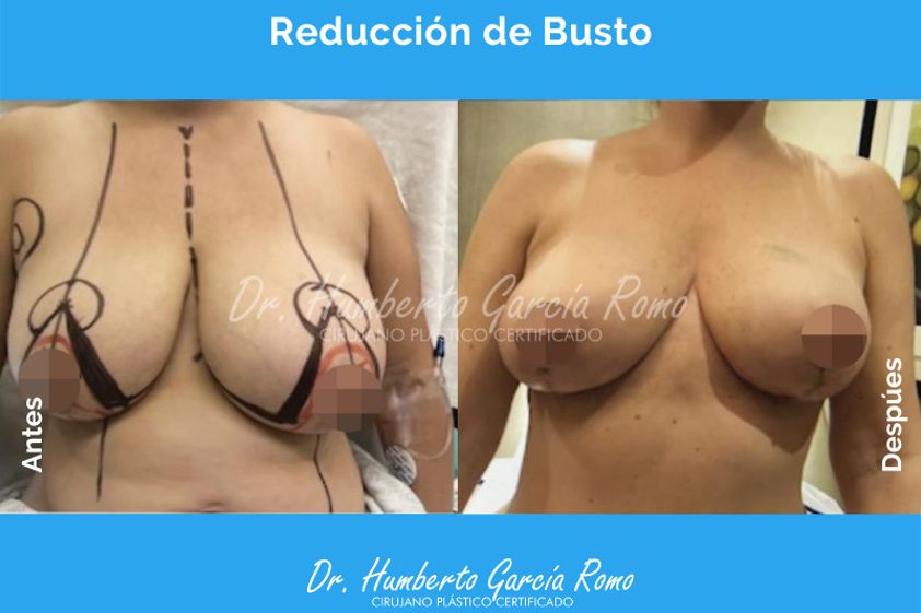 Reducción de mamas antes y después - 868151
