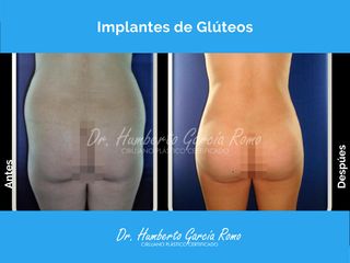 Gluteoplastia - Dr. Jorge Humberto García Romo