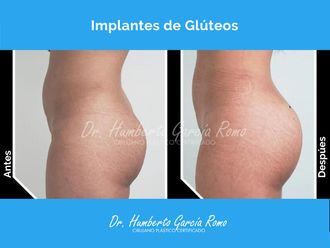 Gluteoplastia antes y después - 869833